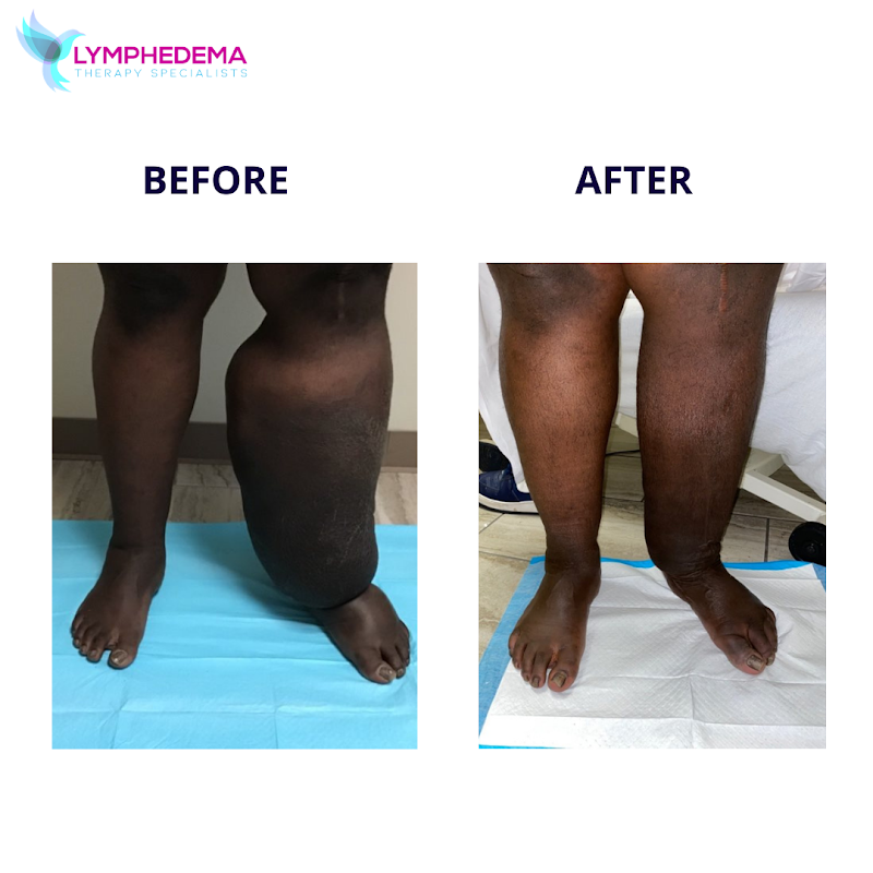 Lymphedema Therapy Specialists – Lymphedema Clinic