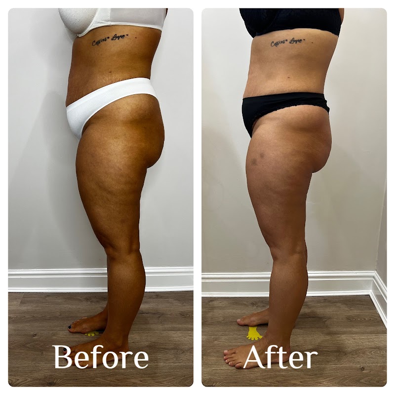 Endermika -Endermologie LPG, body sculpting, non invasive Lymphatic Drainage