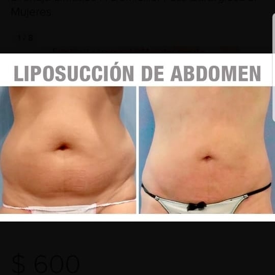 Drenaje Linfático Manual & Tratamientos post quirurgicos